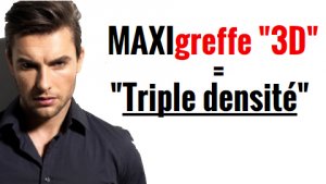 Maxi Greffe 3D : dernières procédures de greffe capillaire