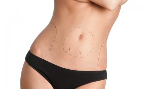 Chirurgie esthétique : les plasties abdominales